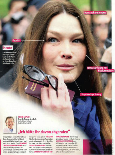 Carla Bruni's Schöhnheitsoperationen
